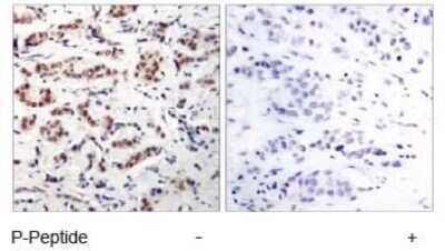 Immunohistochemistry-Paraffin: STAT5A [p Tyr694] Antibody [NB100-82219] - STAT5A [p Tyr694] Antibody [NB100-82219] - Immunohistochemical analysis of paraffin-embedded human breast carcinoma tissue using NB100-82219 (left) or the same antibody preincubated with blocking peptide(right).